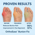 Ortho Ease™ Bunion Fix