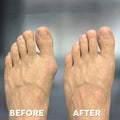 Ortho Ease™ Bunion Fix